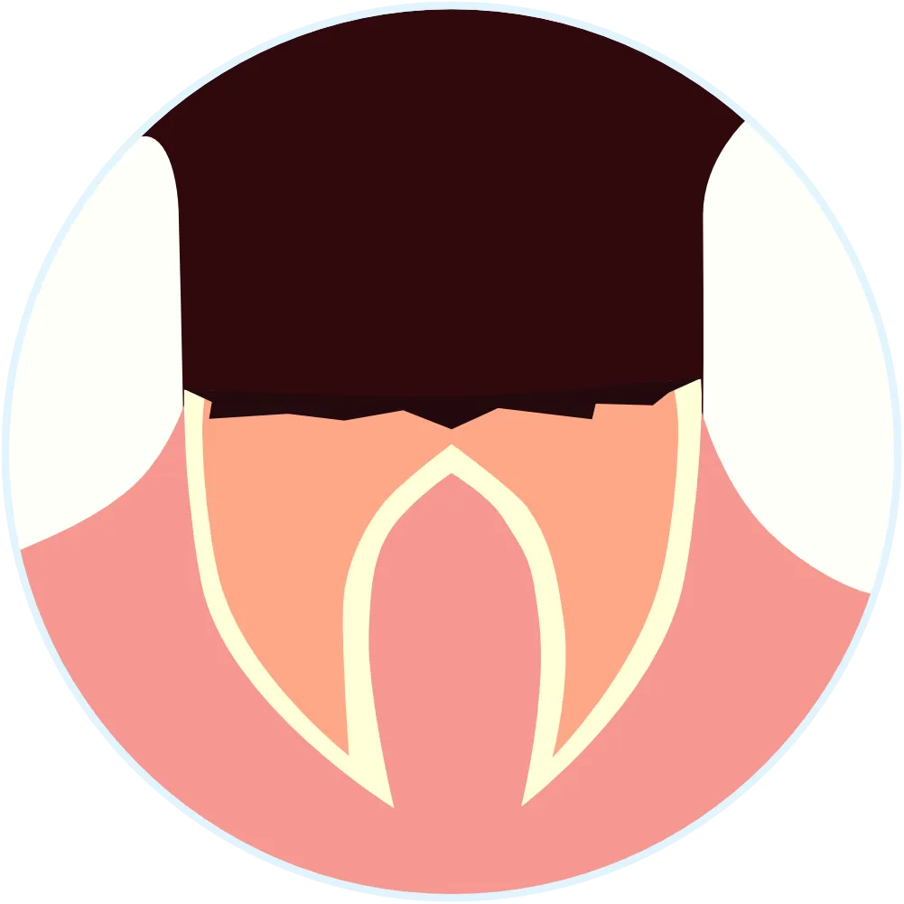 歯根だけになったむし歯のイラスト